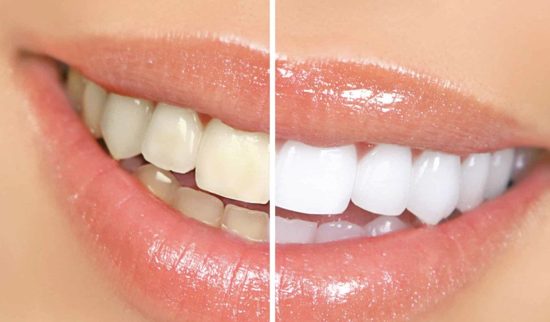 Teeth whitening before and after