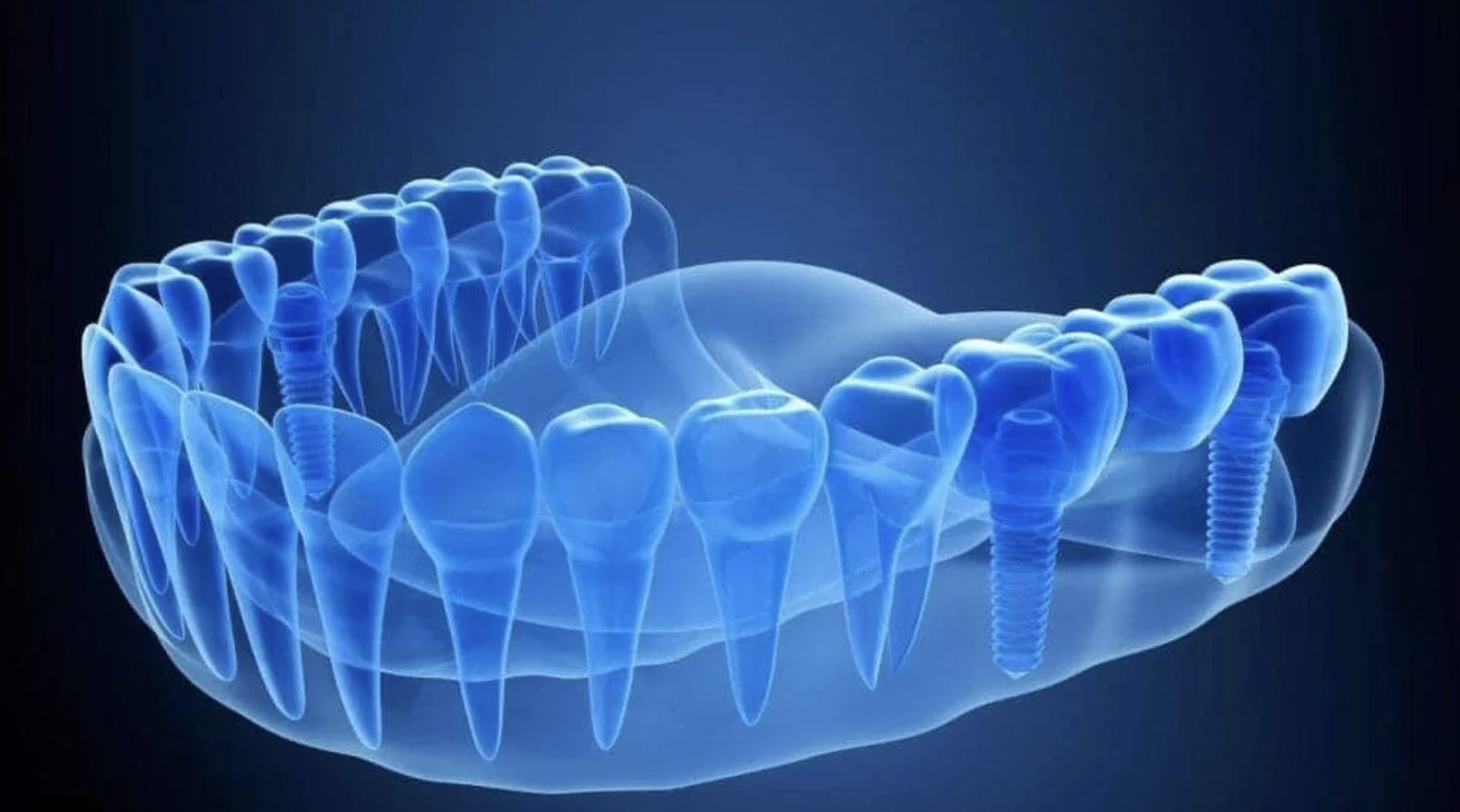 3D X-ray view of teeth and dental implants
